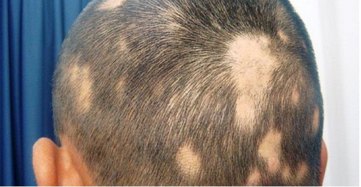 alopecia rimedi