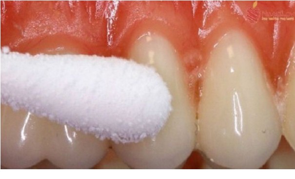 mal di denti rimedi naturali