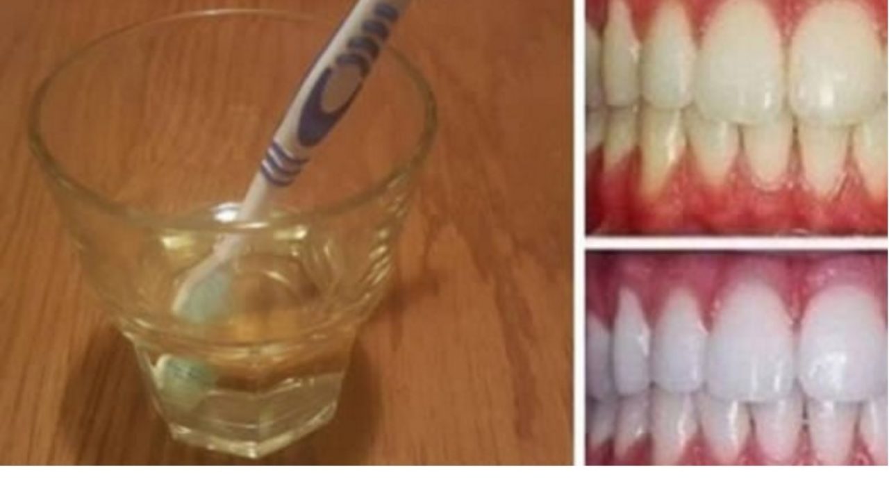 Aceto Di Mele Un Ottimo Rimedio Naturale Per Sbiancare I Denti